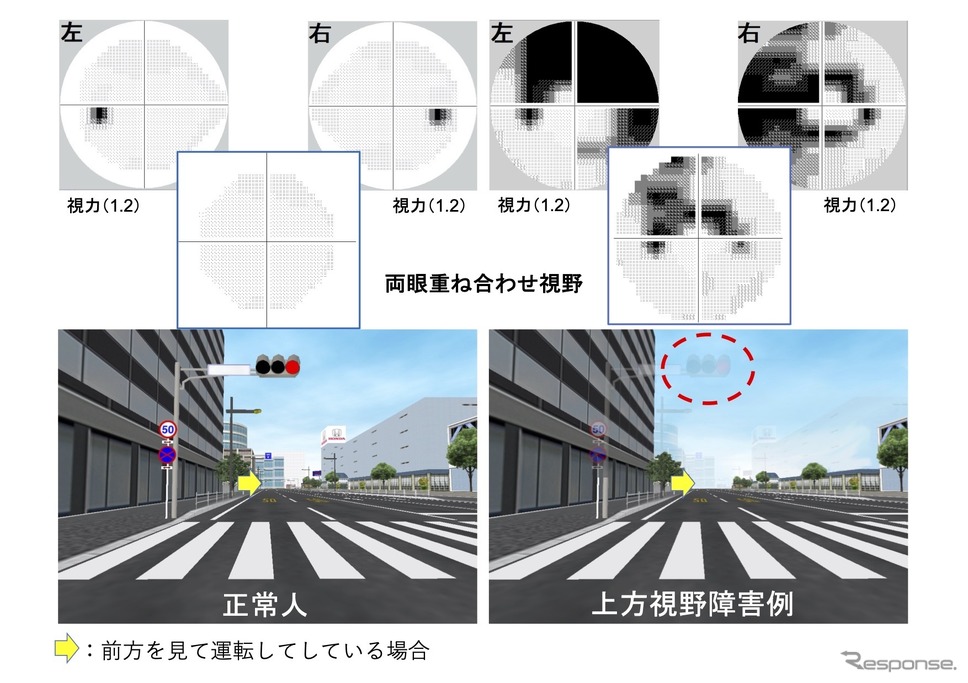 上は視野検査の結果。黒い部分が見えていない。左上は正常な人の視野（黒い部分は盲点。全員にある）。右上は、視野障害があり見えない部分が広がっている人の視野。二人ともそれぞれ、視力は1.2あるものの（免許更新に問題がない）、視野障害がある人の左右両眼を重ね合わせた視野は、ちょど信号を見るあたりが欠けているため、実際には信号そのものが消えて見える。《資料提供 西葛西・井上眼科病院》